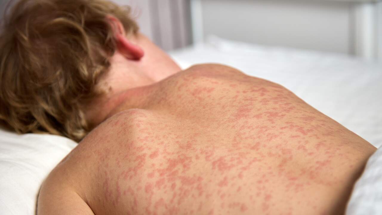 Aantal Kinderen Met Vijfde Ziekte Al Hele Jaar Flink Hoger Dan Vorig 