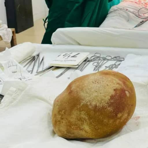 Artsen verwijderen steen van ruim 3 kilo uit blaas van man in Sri Lanka