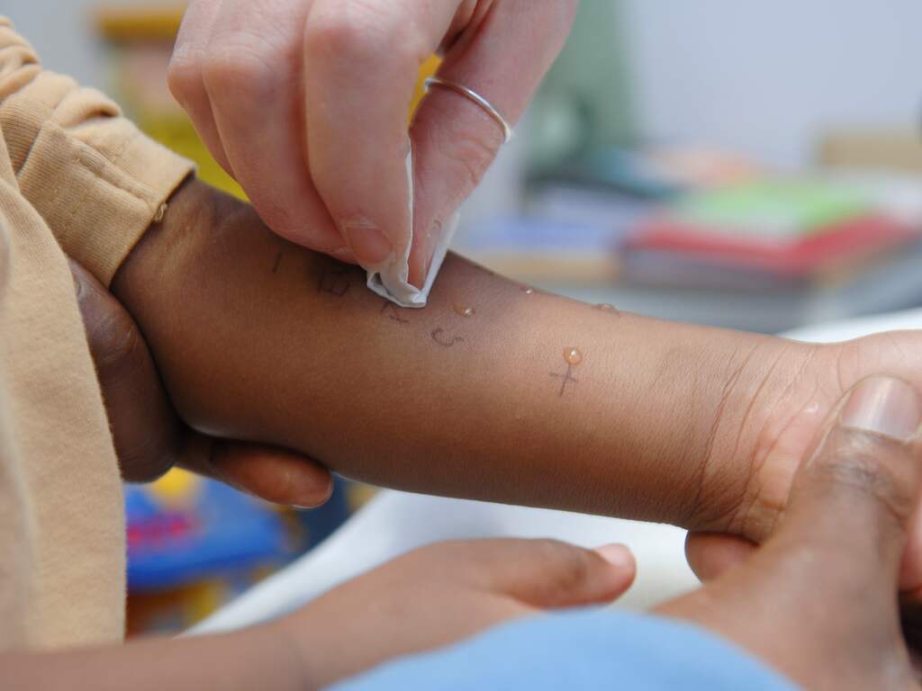 Steeds meer mensen met allergie door verandering van klimaat en leefstijl