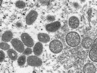 Vijf vragen over de apenpokken, die nu ook in Europa opduiken