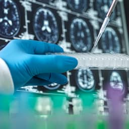 Alsnog positief Europees advies voor medicijn dat verloop alzheimer vertraagt