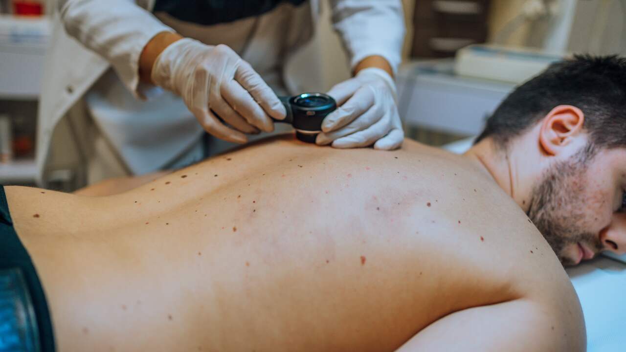 Wanneer moet je je zorgen maken om een moedervlek? | Slimmer leven | NU.nl
