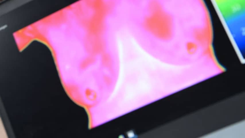 Nog steeds aanbieders van dubieuze screeningmethode voor borstkanker actief