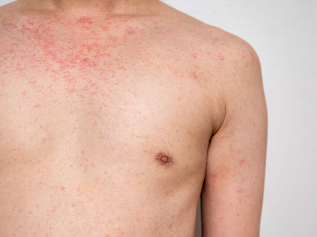 Nu 20 jonge kinderen met mazelen in Zuidoost-Brabant, geen ernstig zieken