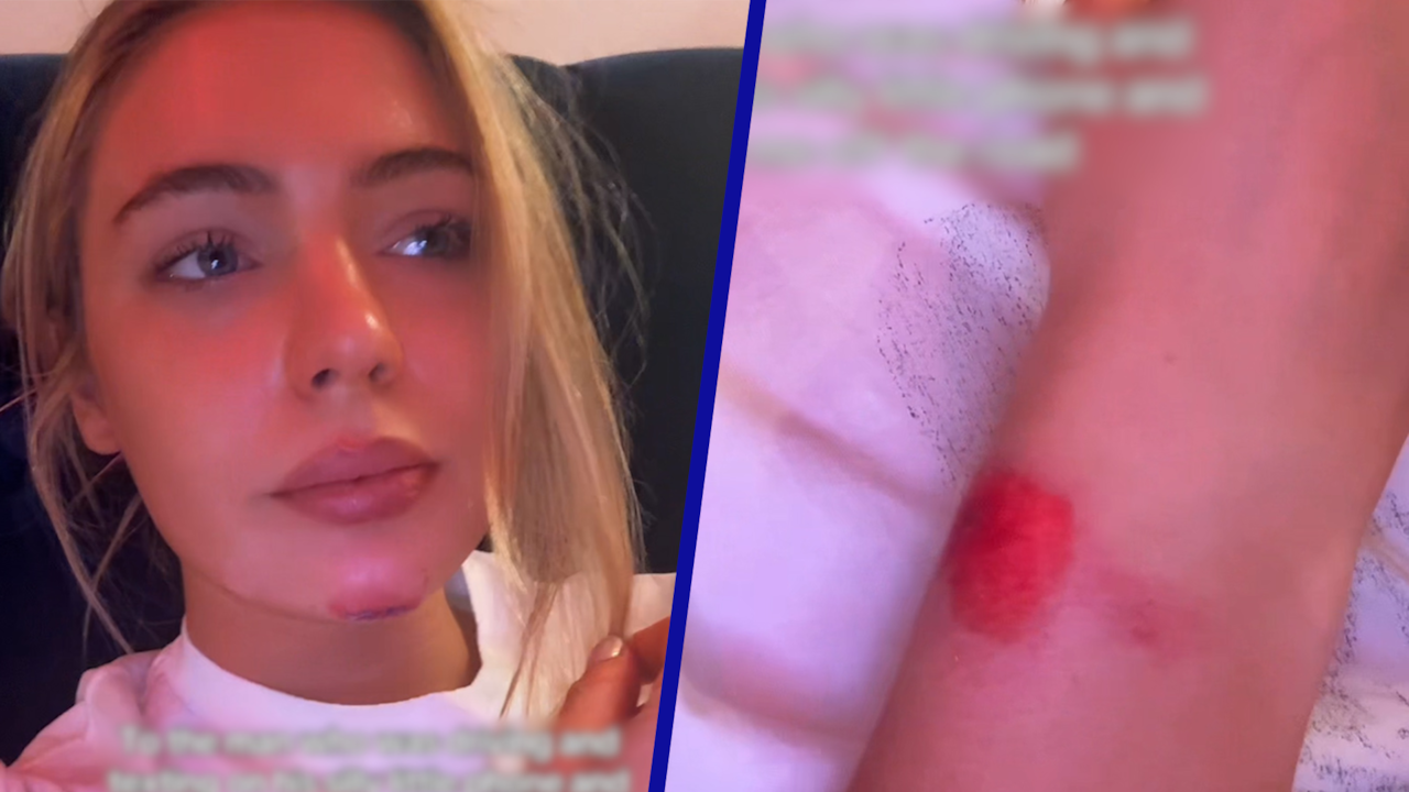 Video | Jutta Leerdam filmt verwondingen na aanrijding met automobilist