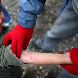 Schurftepidemie in Nederland is hardnekkig: 'Er is geen magic bullet'