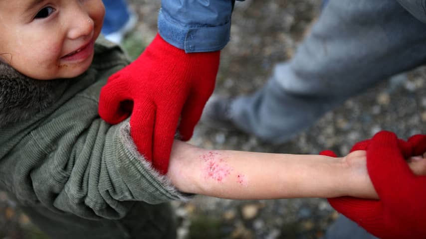 Schurftepidemie in Nederland blijft hardnekkig: 'Er is geen magic bullet'