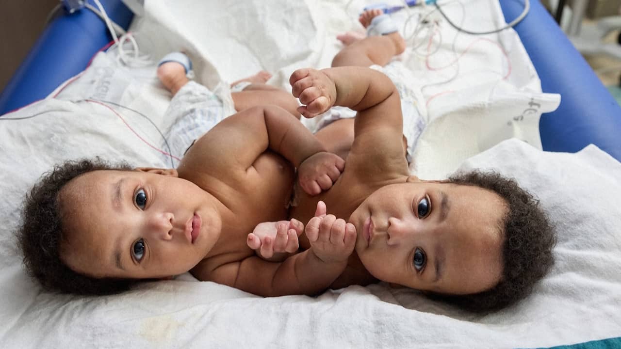 Amerikaanse artsen slagen erin Siamese tweeling te scheiden | NU.nl