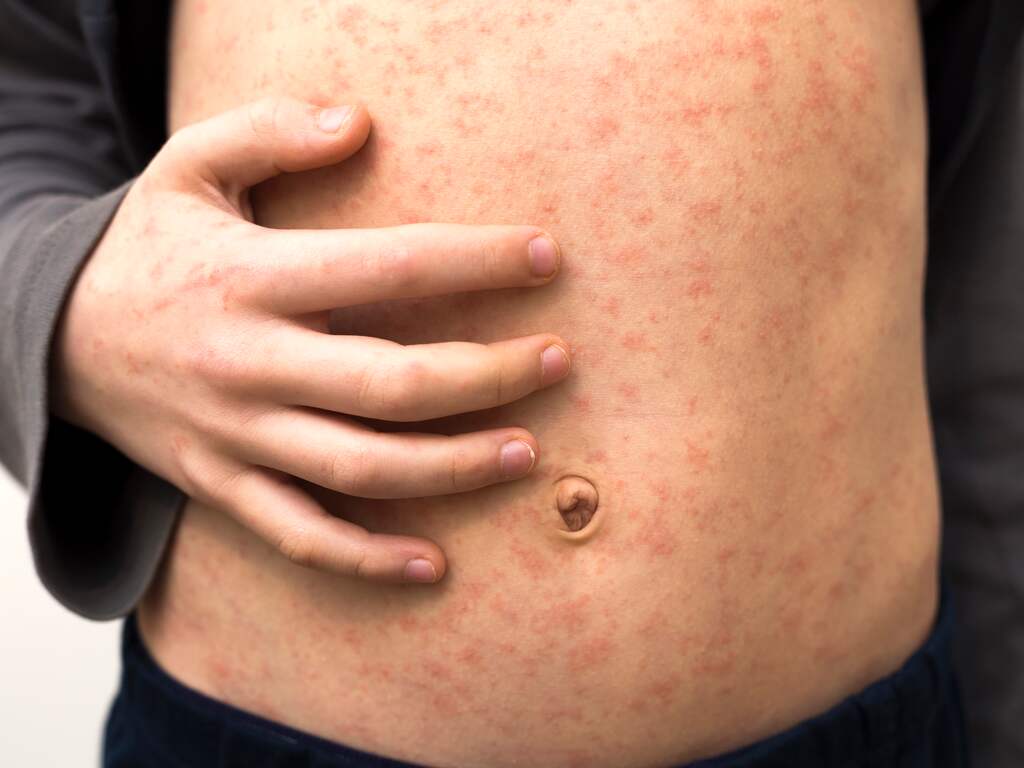 Uitbraak mazelen in regio Eindhoven: veertien kinderen en volwassene besmet