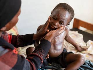 Wereldwijd berichten over mpox, maar de échte zorgen liggen in Afrika